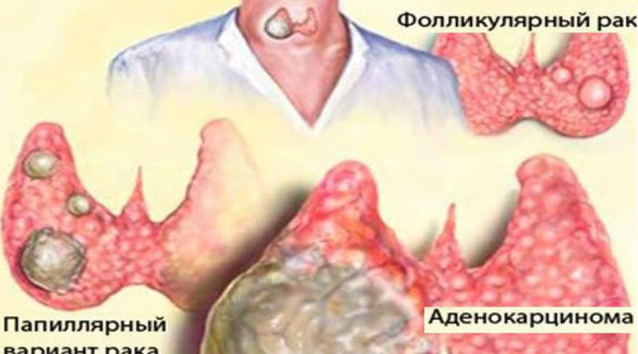 Рак щитовидной железы: карцинома и метастазы. Карциномы щитовидки разнообразны по формам и требуют разных способов лечения