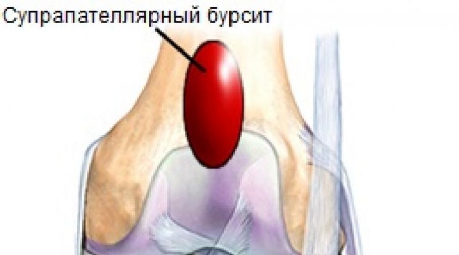 Воспаление суставной сумки коленного сустава. Бурсит коленного сустава симптомы и лечение фото Калькулезный бурсит коленного сустава