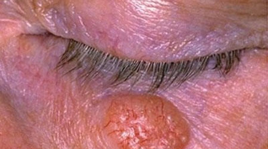 Базалиома последняя стадия. Базалиома кожи лица — симптомы и признаки, чем опасна, фото и питание