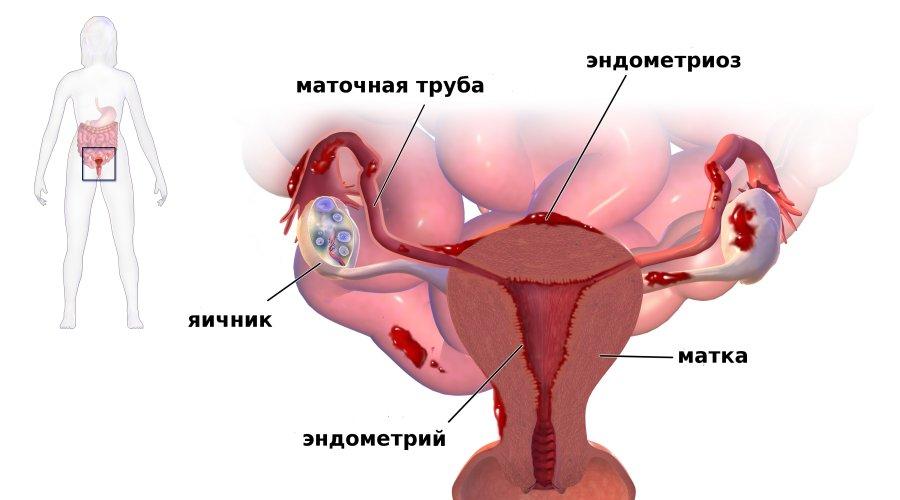 Эндометриоз симптомы и лечение у женщин 30. Эндометриоз
