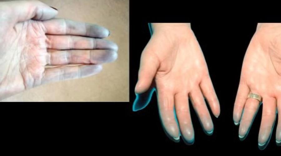 Почему синеют большие пальцы на руках. Почему может посинеть палец на руке