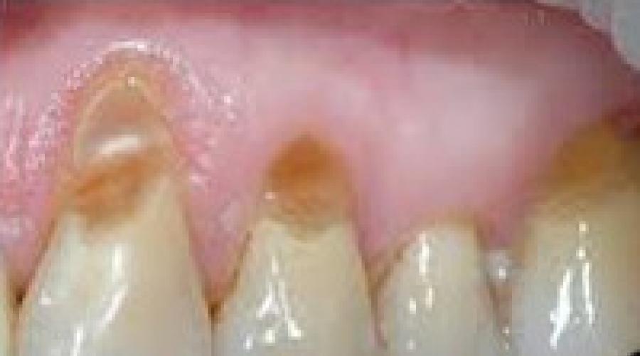 Клиновидный дефект: причины, лечение, профилактика, фото. Клиновидный дефект зубов – все возможные варианты лечения