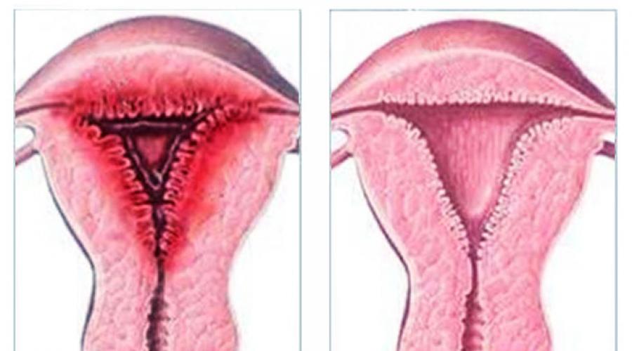 Что такое десквамация в гинекологии. Гистологическое исследование соскобов эндометрия