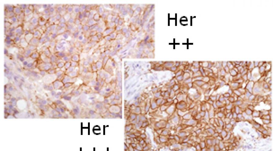 Иммуногистохимическая диагностика рецепторного статуса рака молочной железы (PR, ER, ki67, Her2 neu). Лечение рака молочной железы, негативного по трем рецепторам Позитивный гормональный рецепторный статус соответствует 3 8