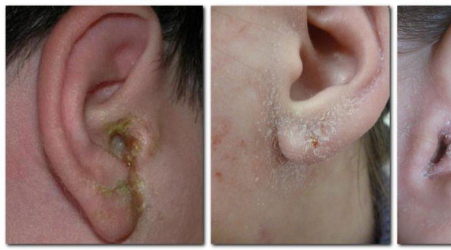 О чем говорит шелушение кожи в ушах: когда нужно начинать беспокоиться. Почему шелушиться кожа в ушах Почему шелушатся ушные раковины снаружи