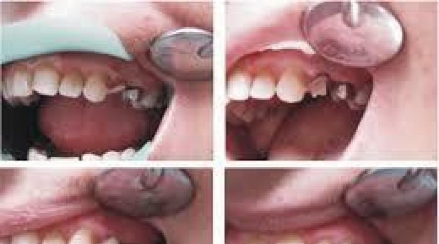 Реставрация зубов: до и после. Художественная реставрация зубов