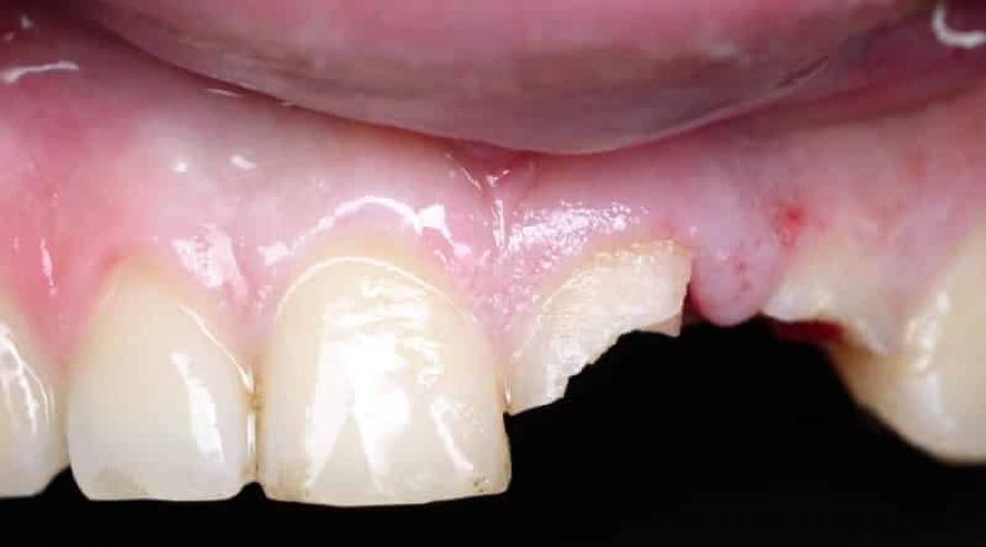 Что можно сделать, если откололся кусочек переднего зуба? Откалываются зубы причины Откололся кусочек жевательного зуба. 