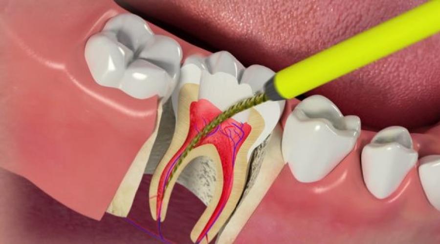 После вставки пломбы болит зуб. Почему болит и ноет зуб после пломбирования при накусывании