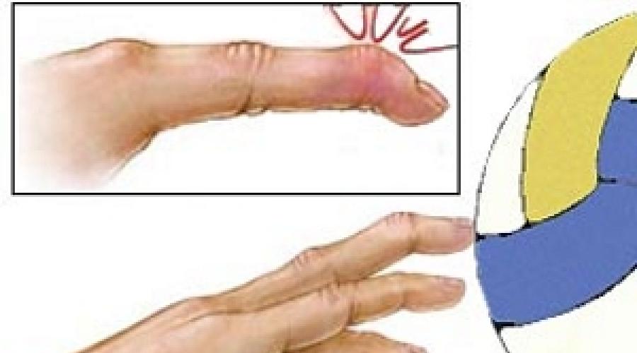 Деформация пальца по типу «бутоньерки» - Разрыв сухожилия разгибающей мышцы. Боли и деформация суставов пальцев рук – первые симптомы ревматоидного артрита Немедикаментозное лечение ревматоидного артрита