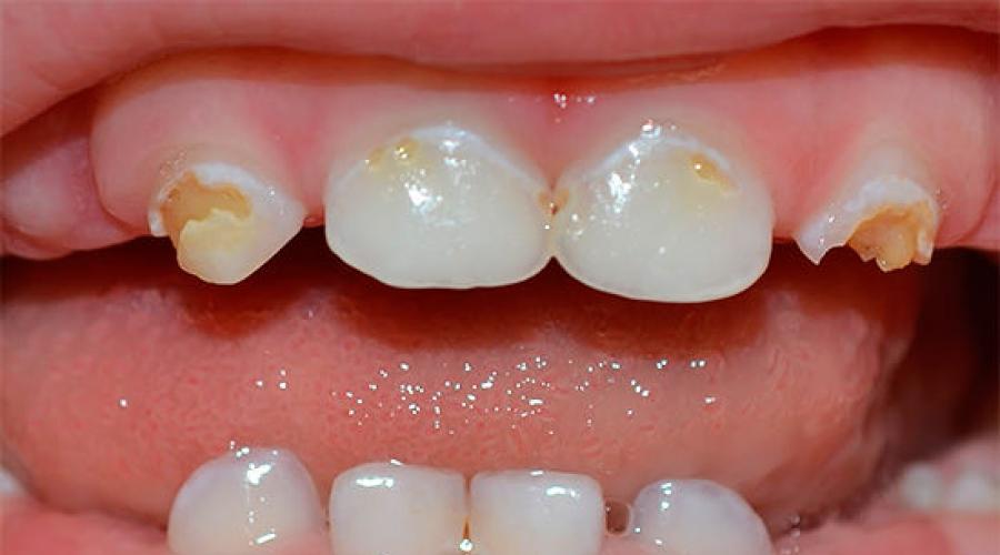 Причины кариеса молочных зубов у детей раннего возраста и способы лечения с фото. Кариес временных зубов у детей раннего возраста: лечить или предупредить