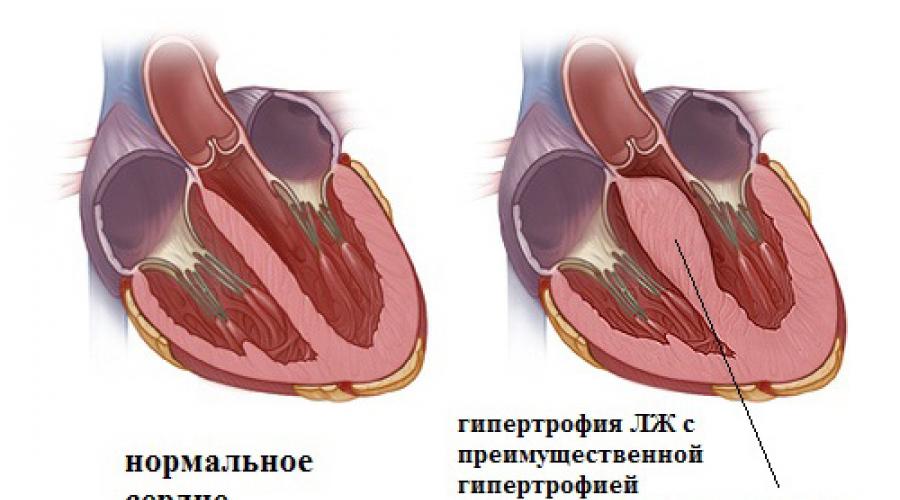 Гипертрофия мжп сердца что это. Другая гипертрофическая кардиомиопатия (I42.2) Гипертрофия перегородки сердца