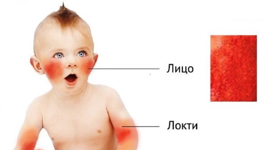 Мелкие точки на теле у ребенка. Виды кожных высыпаний у детей: фото сыпи на груди, спине и по всему телу с пояснениями