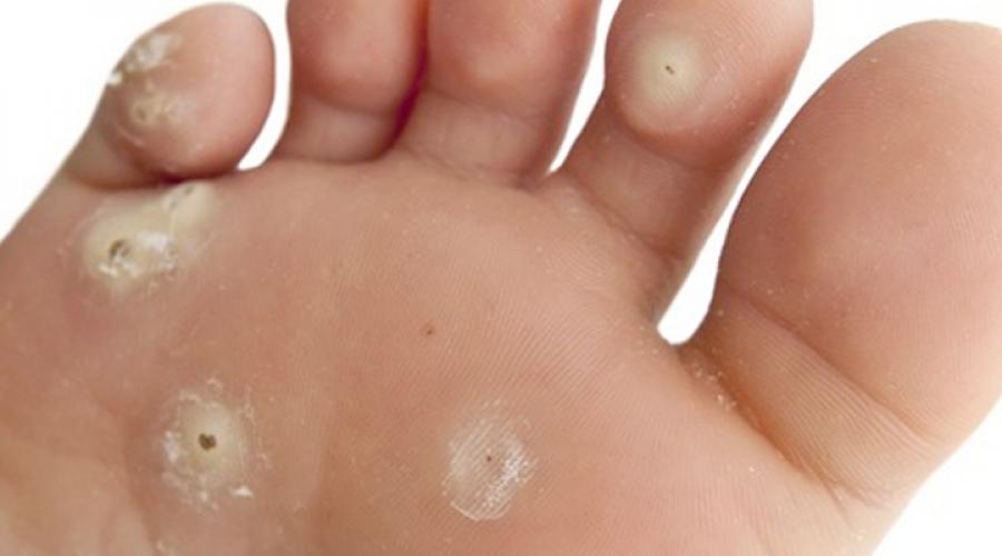 Натоптыши (сухая мозоль) на ноге на пальце и между ними – причины, фото и лечение кожных образований. Как избавиться от натоптышей и сухих мозолей на пальцах ног и ступнях