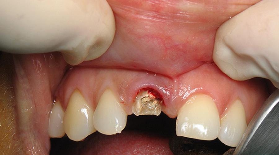Удаление зуба инструменты и методики. Техника удаления зубов щипцами