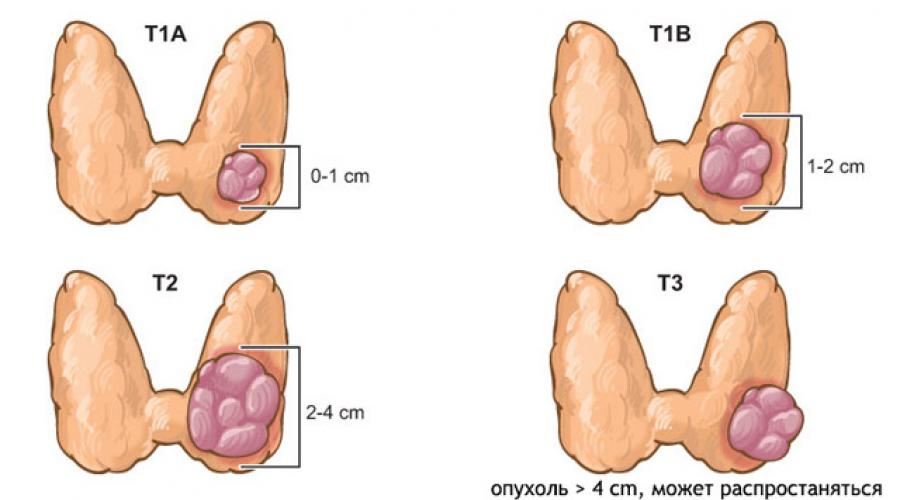Как определить первые признаки рака щитовидной железы. Современные способы диагностики рака
