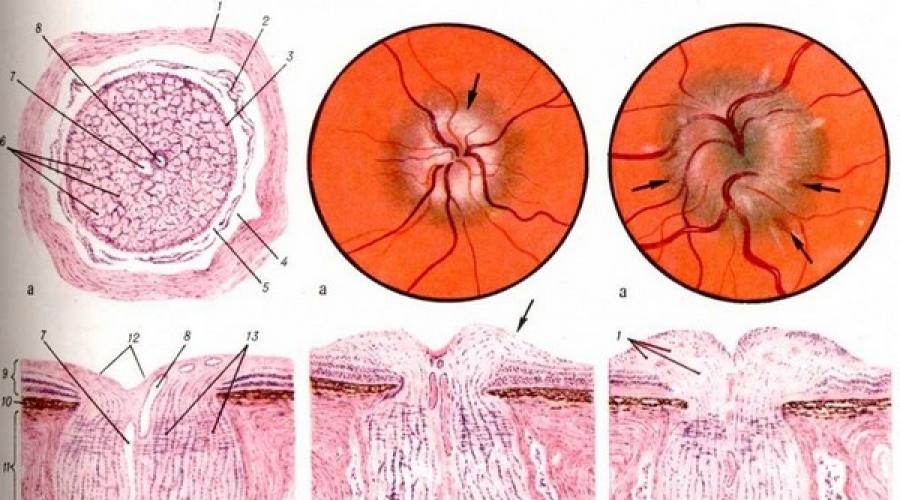 Как проявляется и лечится отек зрительного нерва? Застойный сосок зрительного нерва у детей Лечение застойного диска зрительного нерва. 
