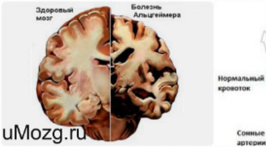 Умеренные дисциркуляторные изменения головного мозга. Очаговые изменения дисциркуляторного характера
