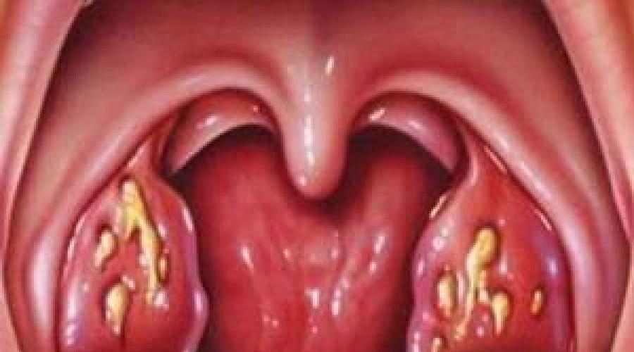 Золотистый стафилококк в горле у взрослых и детей: причины, признаки, диагностика и методы лечения. Методы лечения страфилококка Сапрофитный стафилококк в горле