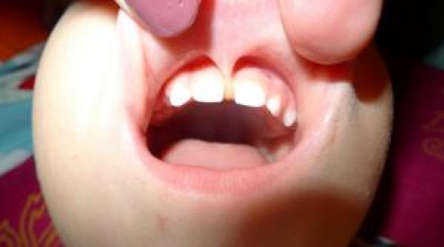 Пластика уздечки верхней губы у детей: виды операций и причины их проведения. Подрезание короткой уздечки языка у ребенка