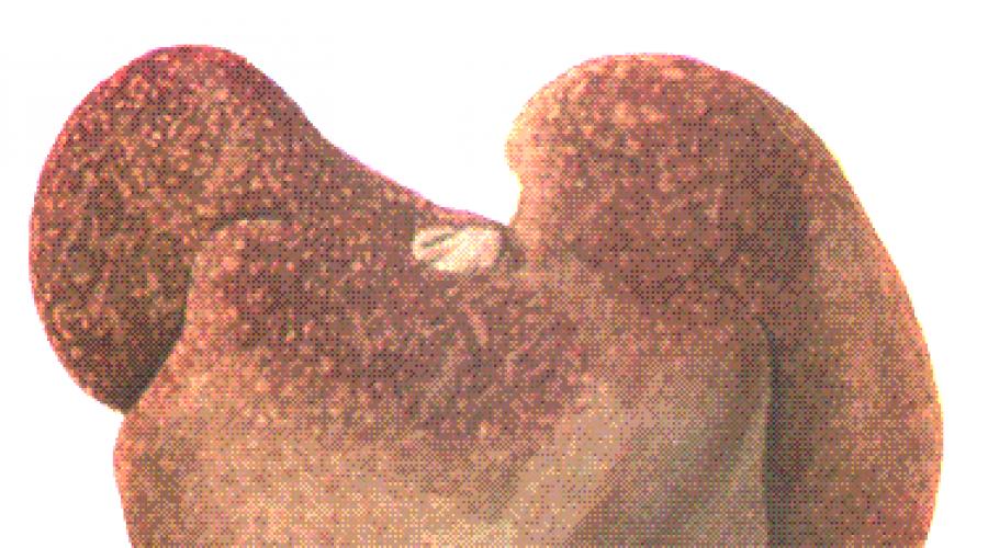Эмфизематозный (шумящий) карбункул. Кожа, кожный покров, подкожная клетчатка