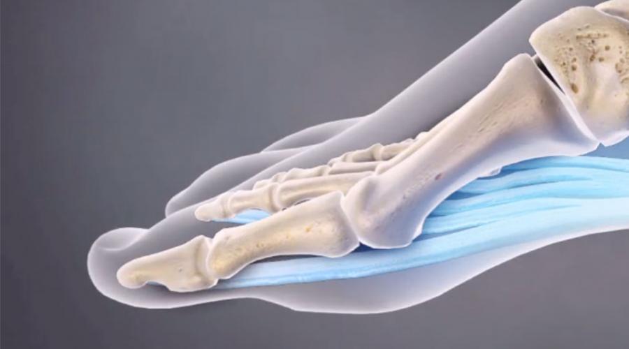 Заболевания пяточной кости. Что означает боль в пятке? Растяжение ахиллова сухожилия