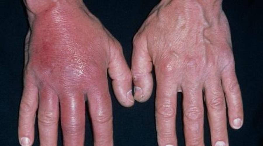 Рожистое воспаление руки. Рожистое воспаление (Рожа) - причины, симптомы, диагностика и лечение