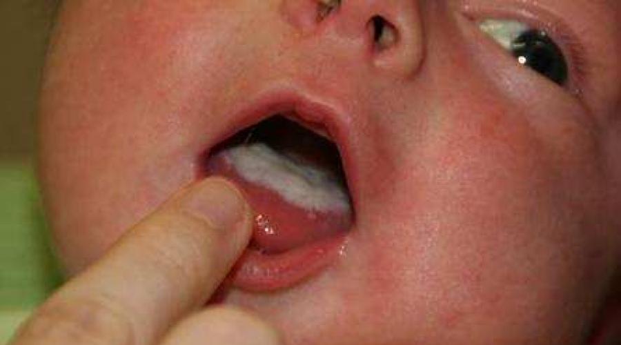 Белый налет на слизистой рта у ребенка. Что значит: нормальный влажный климат? Причины налета на языке