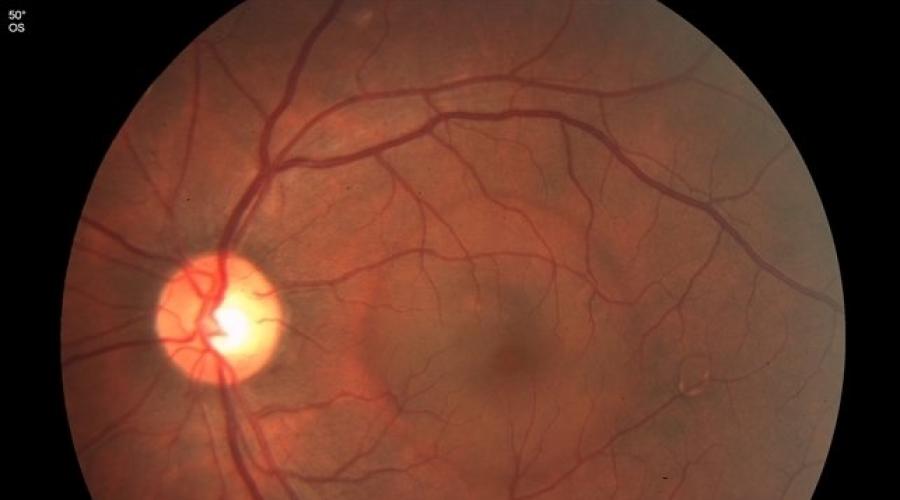 Анализ глаза признаки активной снм 2 типа. Болезни глаз