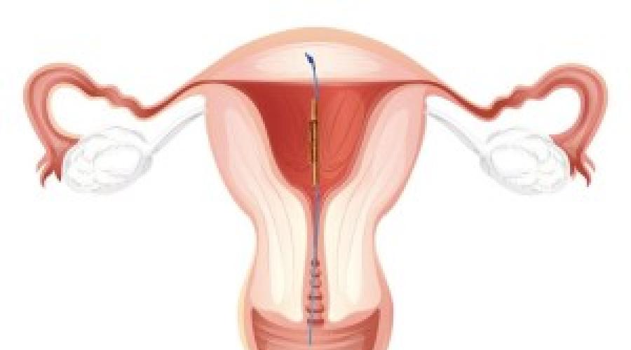 Короткая шейка матки при беременности и риск преждевременных родов. Укороченная шейка матки при беременности лечение Укорочение сомкнутой части шейки матки