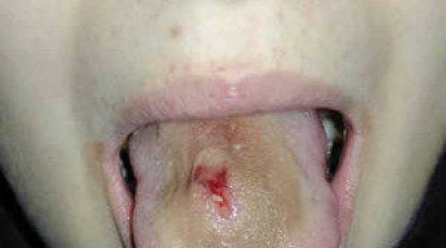 Что вызывает воспаления под языком и как их лечить. Почему болит уздечка языка