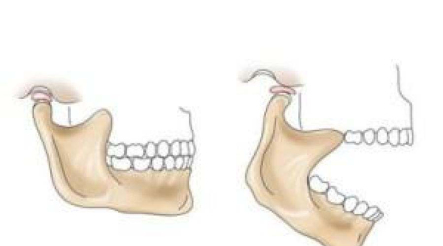 Почему при открытии рта и когда жуешь может болеть челюсть возле уха, каковы сопутствующие симптомы и что делать? Просмотр полной версии Не могу широко открыть рот. 