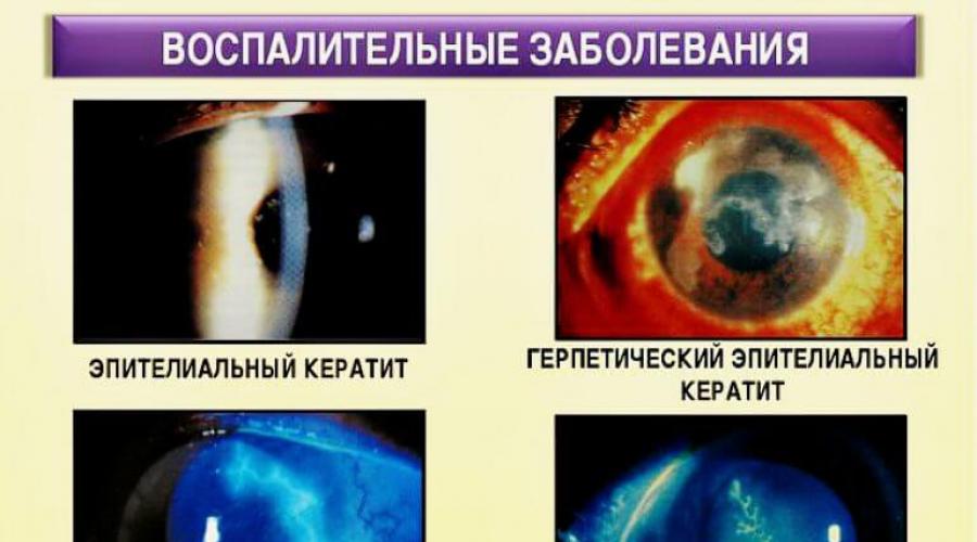 Заболевание роговицы глаза кератит. Прогноз и меры профилактики