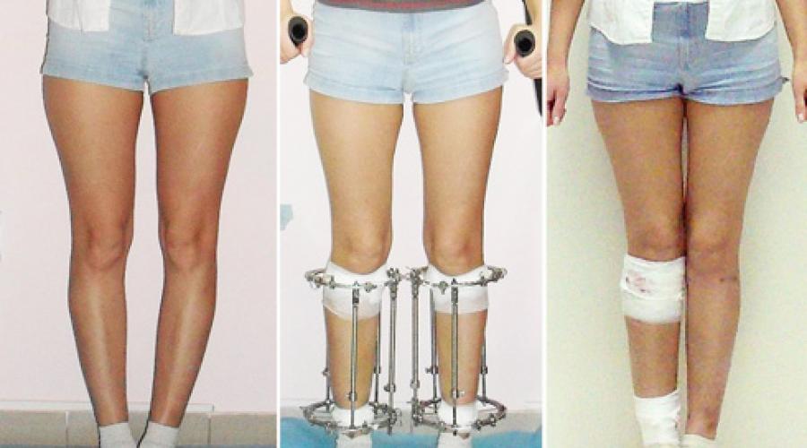 Что такое аппарат илизарова. Метод Илизарова для удлинения костей Почему ноги могут иметь разную длину
