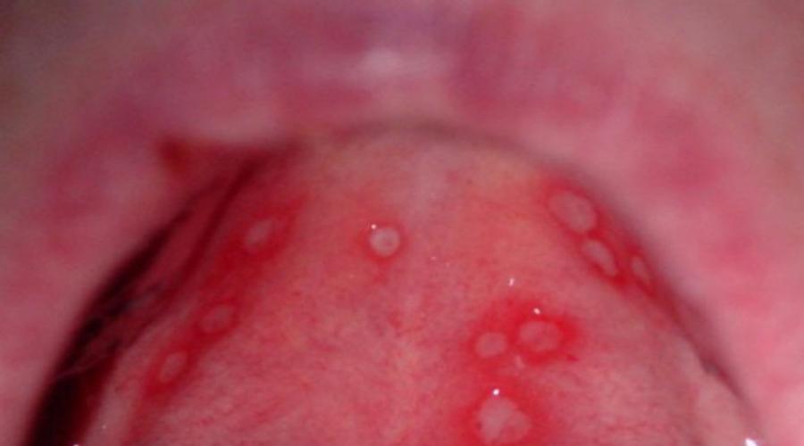 Чем характеризуется вирусный стоматит у детей и как его лечить? Вирусный стоматит — воспаление мягких тканей во рту Вирусный стоматит. 