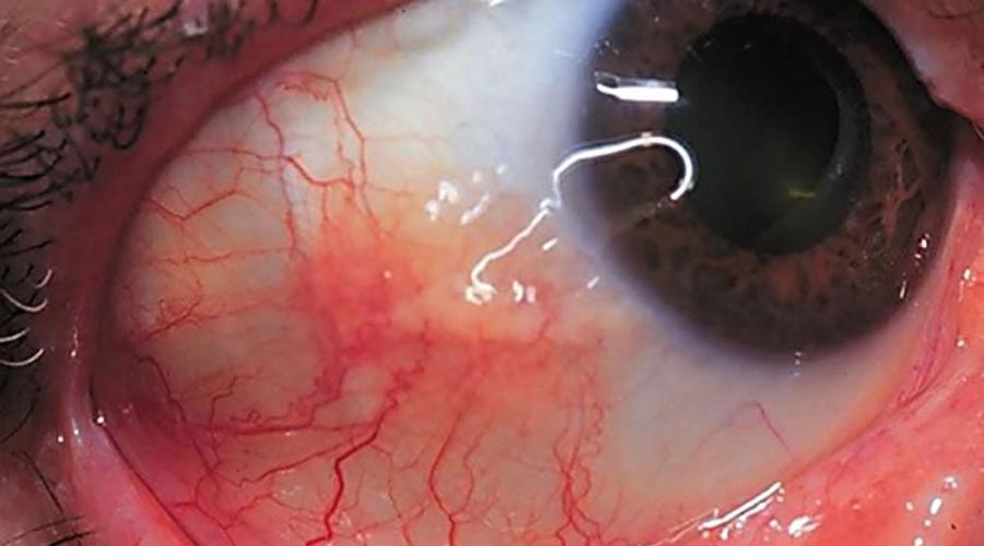 Аллергическая реакция на глазах: что можно предпринять самостоятельно? Заболевания наружной оболочки глаза. Диагностика и лечение Склерит симптомы