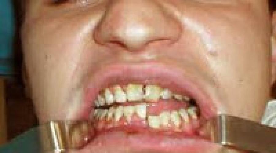 Перелом нижней (верхней) челюсти: лечение в домашних условиях. Лечение перелома челюсти