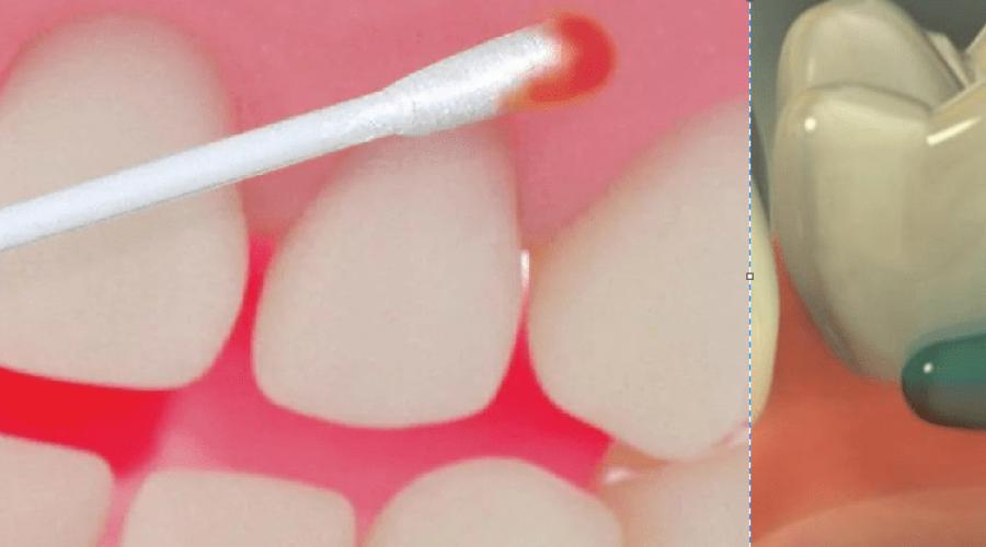 Что используют стоматологи для обезболивания. Зубная анестезия