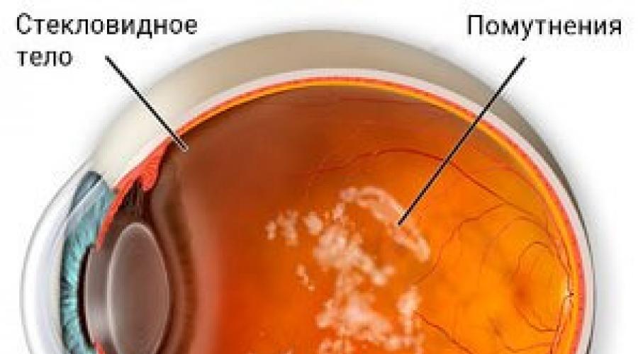Плавающие черные точки в глазах: причины и методы избавления. Симптомы отслоения стекловидного тела: чёрные точки перед глазами Смотришь видишь черную точку