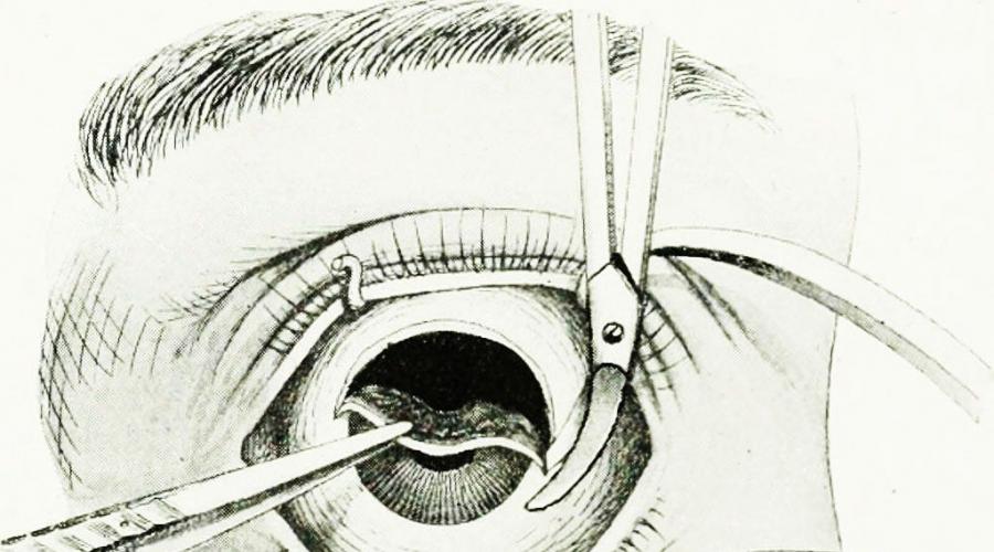 Операция по удалению глаукомы: как проходит, показания и последствия. Операция при глаукоме: хирургическое антиглаукоматозное лечение Лазерная коррекция глазного давления