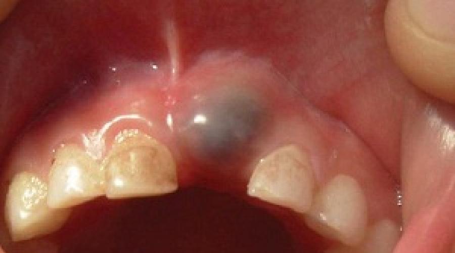 Опасна ли киста на корне зуба. Киста на корне зуба: симптомы, удаление (резекция), терапевтическое лечение в домашних условиях