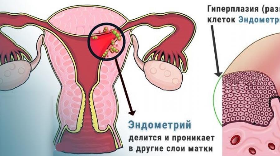 Лечение хронического эндометрита народными средствами. Лечение эндометрии матки народными средствами