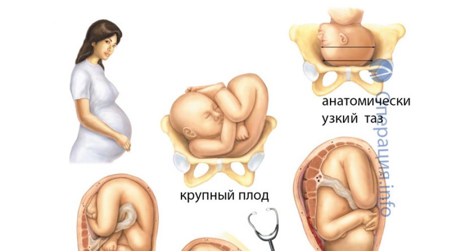 Как проходит операция кесарева сечения. Тяжелые патологии со стороны матери, связанные и не связанные с беременностью