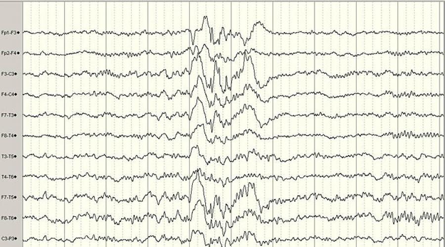 ЭЭГ при симптоматической эпилепсии. Расшифровка показателей электроэнцефалограммы (ЭЭГ) головного мозга Региональное замедление