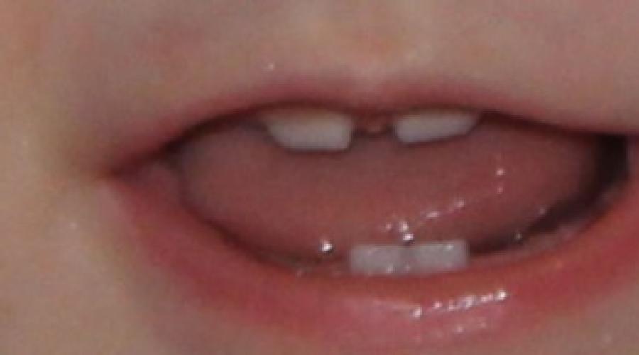 Как убрать щель между передними зубами. Щель между передними зубами: недостаток или изюминка