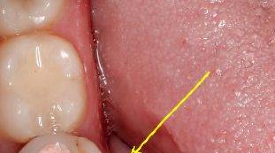 Что делать, если поставили пломбу с мышьяком, а зуб болит: почему это происходит? Мышьяк в зубе: проверенная классика или скрытая угроза. 