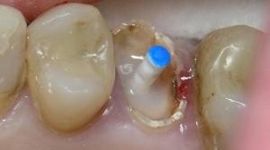 Чем опасны плохие зубы. Последствия гнилых зубов для здоровья
