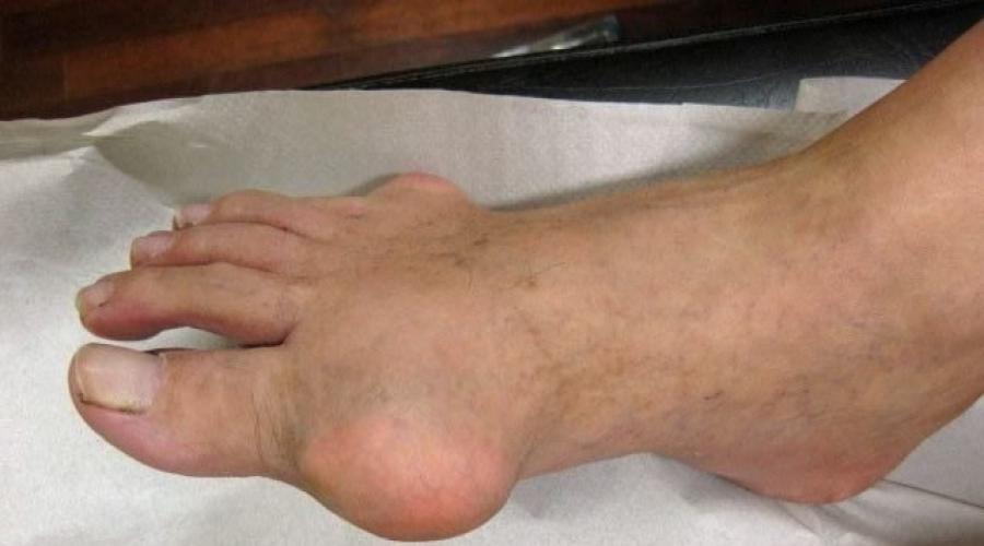 Лечение артрита пальцев ног. Артрит пальцев ног – причины, симптомы, диагностика, лечение