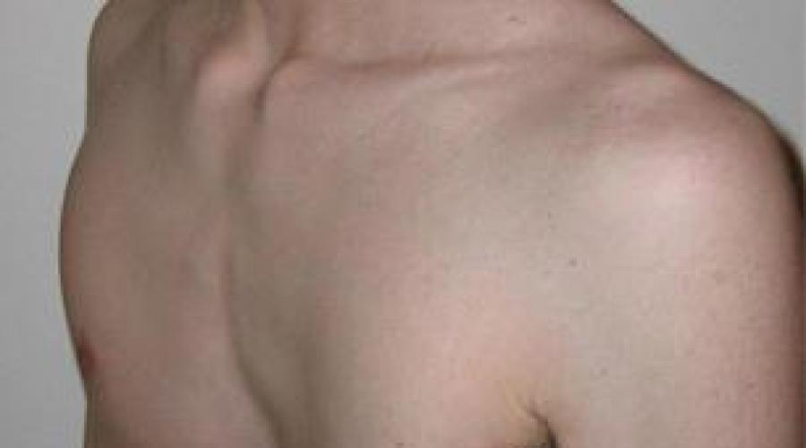 Форма грудной клетки у младенцев: нормы и отклонения. Деформации грудной клетки