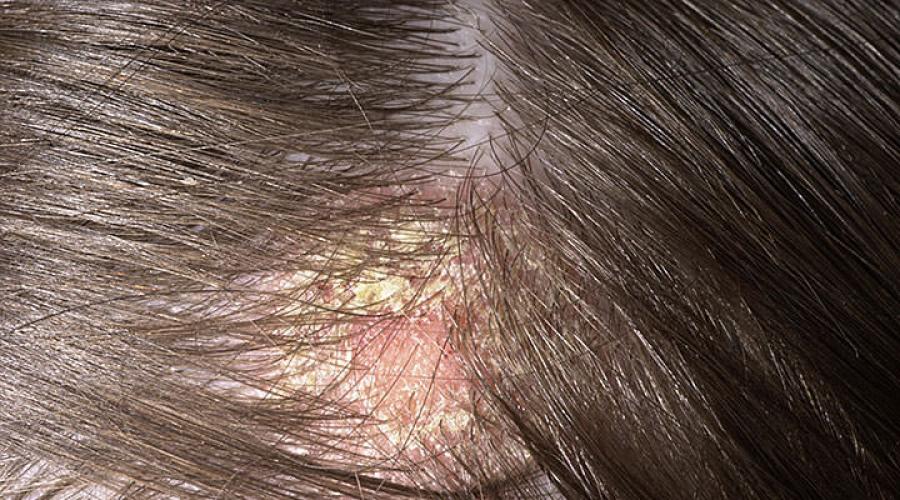 Заболевания кожи головы лечение. Симптомы данных заболеваний кожи головы