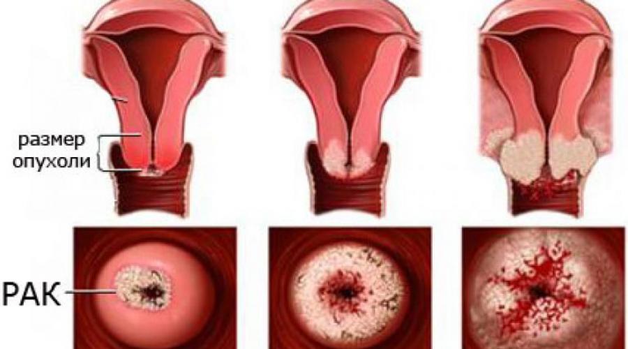 Рак шейки матки — стадии, первые признаки и симптомы, лечение, прогноз. Гинекологический осмотр с помощью зеркал